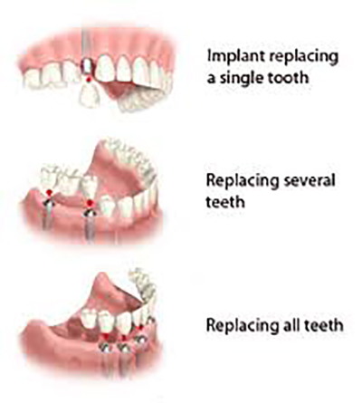Diagram showing various types of dental implants available from Chatswood Dental Care