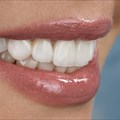 6 Things You Can Do To Keep Your Porcelain Veneers Shiny And White