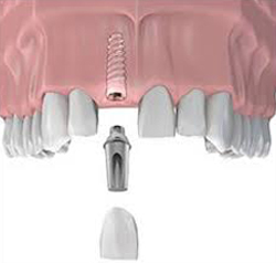 Dental Implants