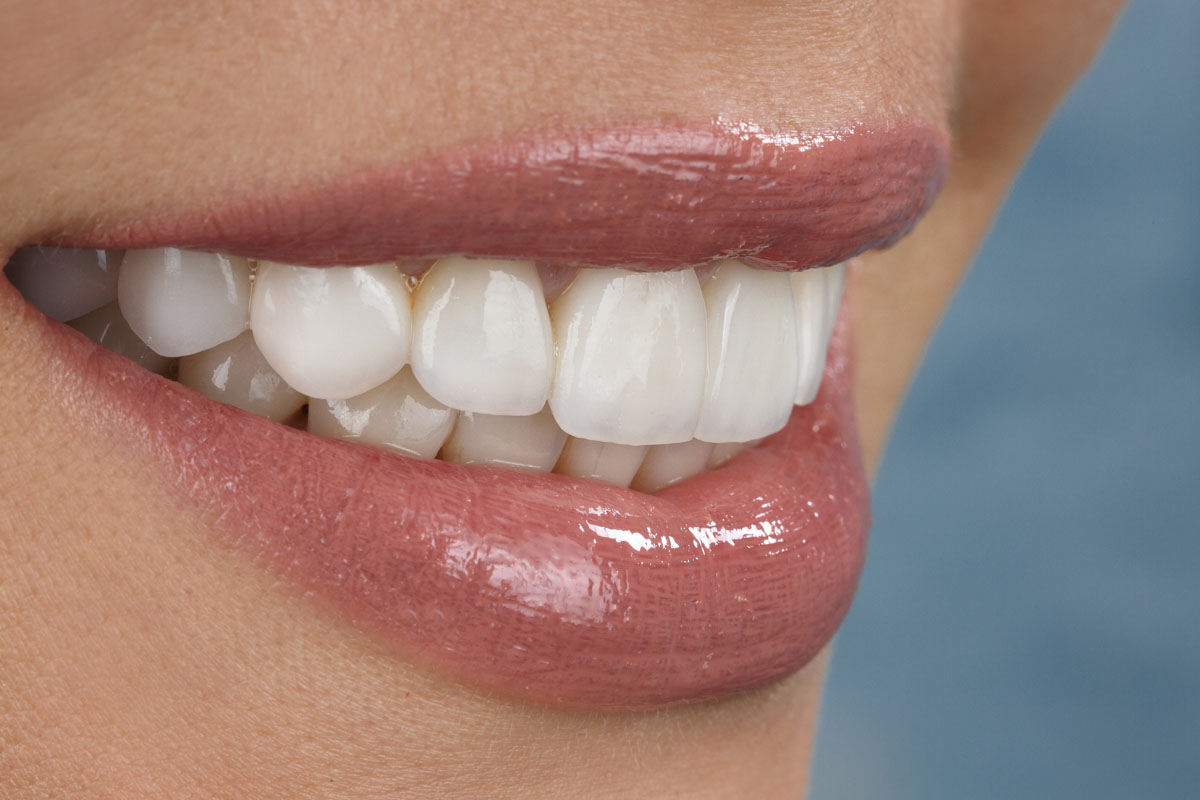 6 Things You Can Do To Keep Your Porcelain Veneers Shiny And White