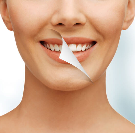 Teeth Whitening Chatswood Dental